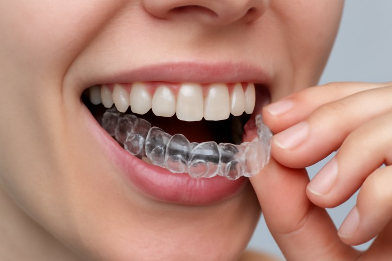 Şeffaf Plak Tedavisi Nedir - (Invisalign) Fiyatı 2026