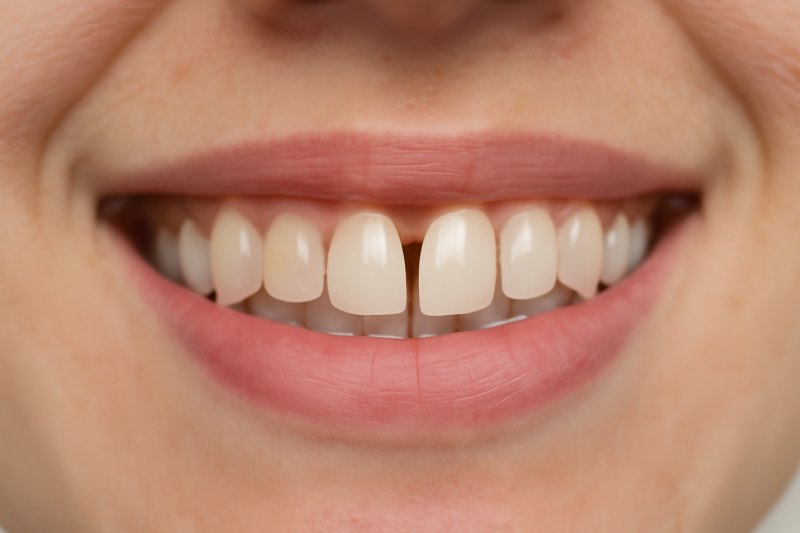 Dişler Arasında Boşluk (Diastema) Nedir?